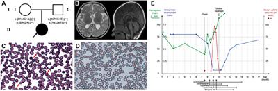 Case Report: Rapid Treatment of Uridine-Responsive Epileptic Encephalopathy Caused by CAD Deficiency